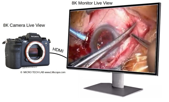 Live Videoübertragung zu einen externen Monitor, top Bildqualität,4K oder 8K, Zeiss OP-Mikroskop, Spaltlampe Zeiss OPMI Okulartubus mit 8K Monitor Kamera
